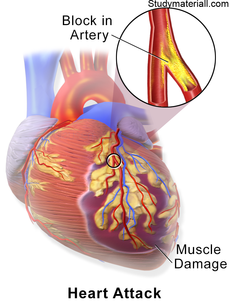 Acute Myocardial Infarction, What is the main cause of a myocardial infarction? What is the difference between a heart attack and a myocardial infarction? What are the 4 silent signs of a heart attack? 26