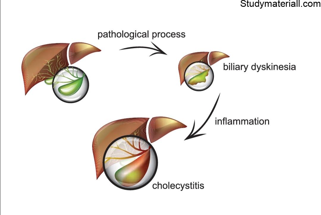 Cholecystitis, Inflammation of the gall bladder, signs and symptoms 36