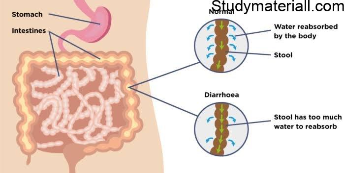 Diarrhoea - Common causes of diarrhoea, Preventive Measures of diarrhoea,symptoms of diarrhoea 2
