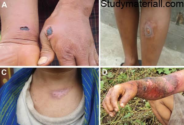 Anthrax, What is Anthrax, Animal Infections, 51