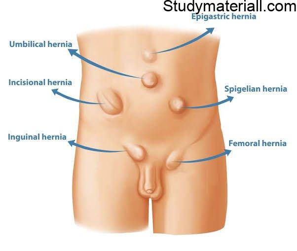 What is hernia,Types of Hernia, Classification of Hernia, Symptoms of hernia, Treatment and management of hernia 2