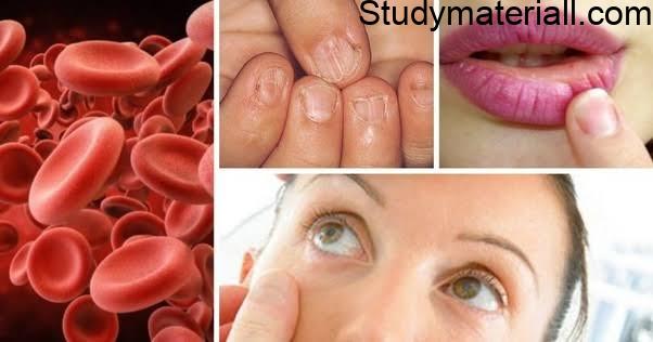 What is Anaemia, causes of anemia, symptoms of anaemia, Types of Anaemia, Complications of Anaemia 23