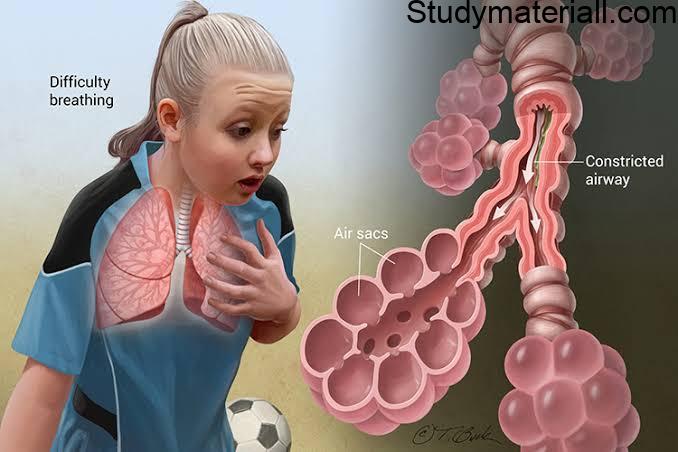 Asthma,causes of asthma, Symptoms of Asthma, 19