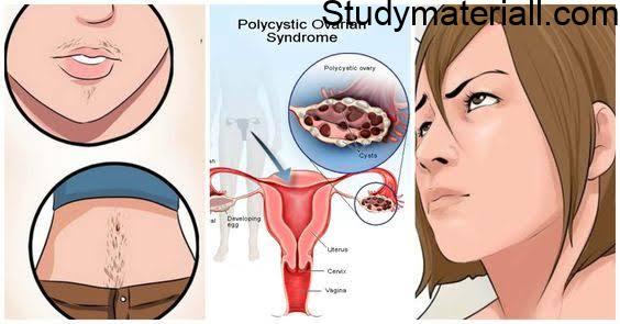 Poly Cystic Ovarian Syndrome/Disease (PCOD), signs and symptoms of ovulatory dysfunction, polycystic ovaries, and hyper and rogenism, Management and treatment for PCOD 52