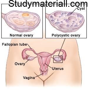 Poly Cystic Ovarian Syndrome/Disease (PCOD), signs and symptoms of ovulatory dysfunction, polycystic ovaries, and hyper and rogenism, Management and treatment for PCOD 3
