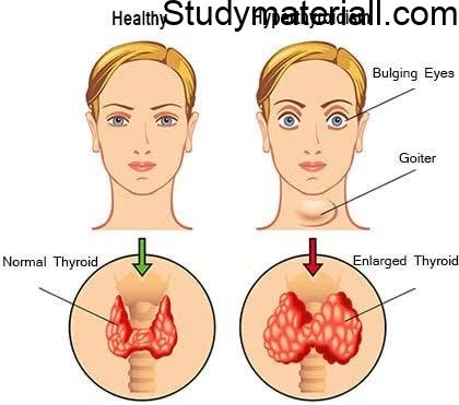 What is Hyperthyroidism, Causes of Thyroid, Signs and symptoms of thyroid, thyroid diagnosis 4