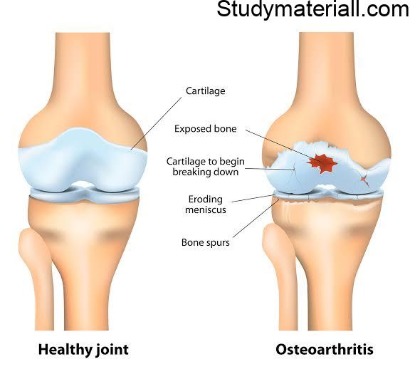 Osteoarthritis,Common chronic disorders, Knee Joint Pains, Knee pain, Causes of knee pain, Treatment for Knee joint pains 59