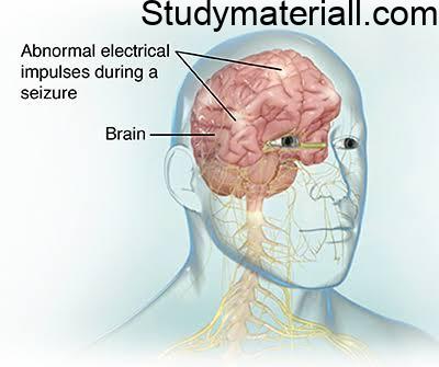 Epilepsy,Neurological disorder,Brain Illness, Causes of Neurological disorder, Symptoms of Epilepsy 48