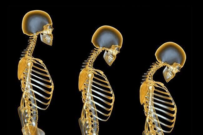 What is Osteoporosis, Low bone mass and Bone tissue disease, Causes of Osteoporosis, signs and symptoms of Osteoporosis 56
