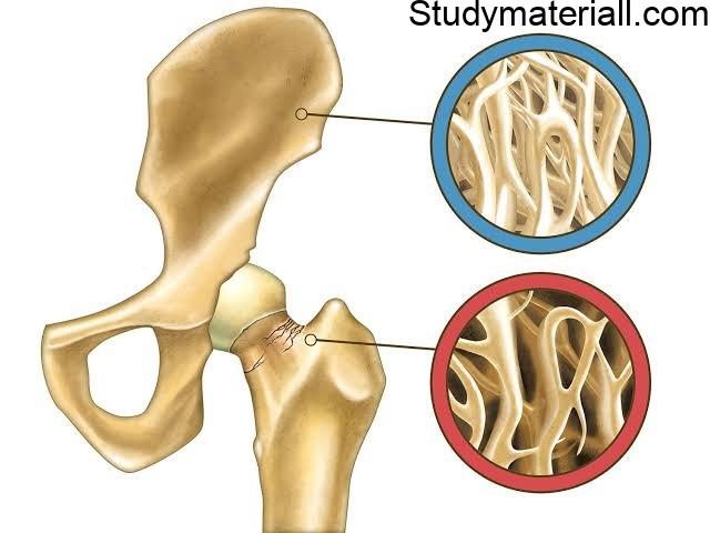 What is Osteoporosis, Low bone mass and Bone tissue disease, Causes of Osteoporosis, signs and symptoms of Osteoporosis 2