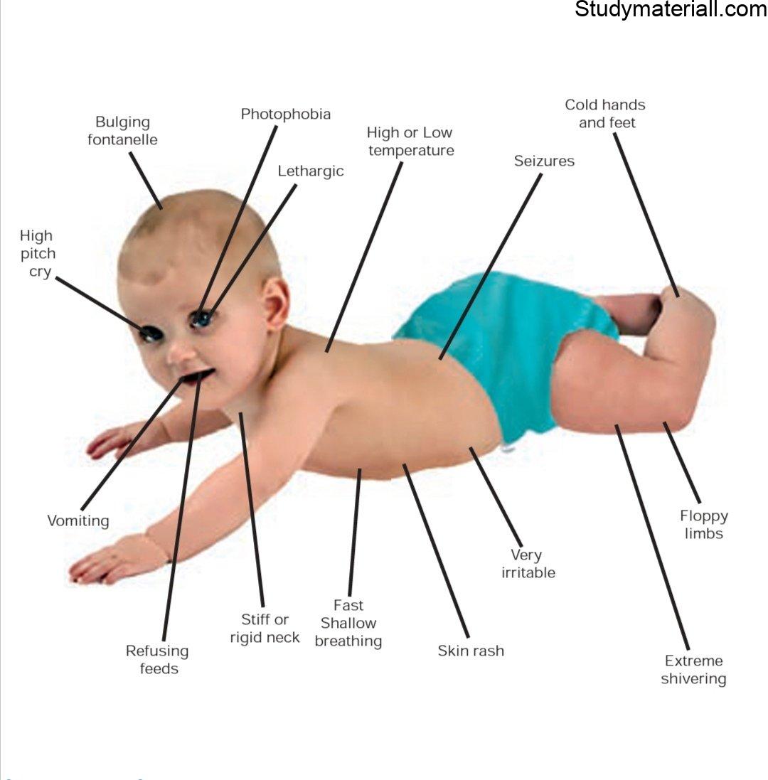 Encephalitis, brain inflammation or Swelling disease,Main cause of encephalitis, Symptoms of encephalitis, Symptoms of new born and infants 3