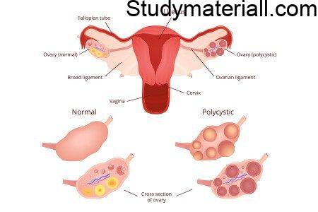 Poly Cystic Ovarian Syndrome/Disease (PCOD), signs and symptoms of ovulatory dysfunction, polycystic ovaries, and hyper and rogenism, Management and treatment for PCOD 2