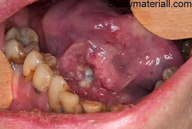 Oral Cancer,Types of Oral Cancer,Lip Cancer Symptoms and management, Tongue Cancer Symptoms and Management, Oral cavity Cancer Symptoms and Management 2