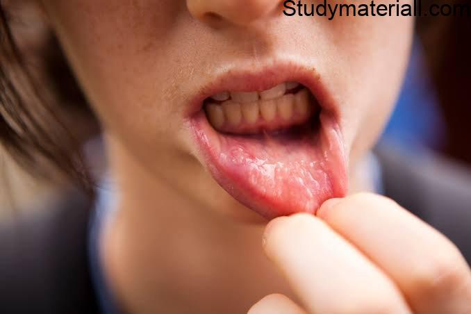 Oral Cancer,Types of Oral Cancer,Lip Cancer Symptoms and management, Tongue Cancer Symptoms and Management, Oral cavity Cancer Symptoms and Management 3