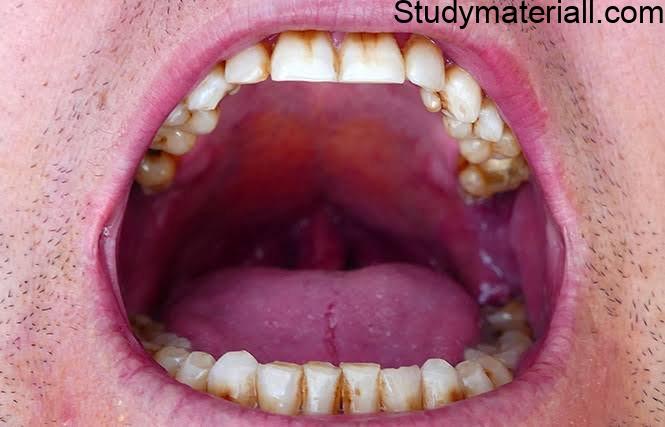 Oral Cancer,Types of Oral Cancer,Lip Cancer Symptoms and management, Tongue Cancer Symptoms and Management, Oral cavity Cancer Symptoms and Management 5