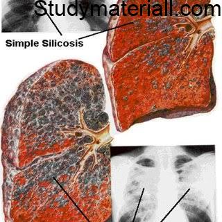 Occupational Disorders - Silicosis,signs and symptoms of Silicosis disorder 30